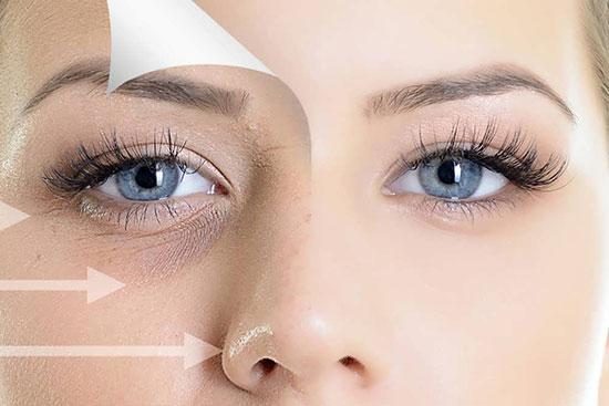 فیلر زیر چشم، رفع گودی و سیاهی زیر چشم فیلر زیر چشم، برطرف گودی و سیاهی زیر چشم