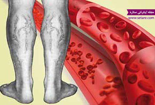 بیماری واریس چیست؟ بیماری واریس چیست؟